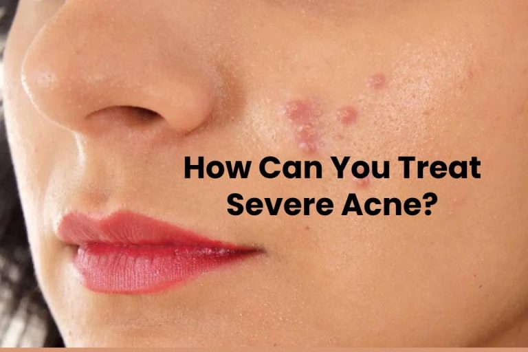 How Can You Treat Severe Acne?