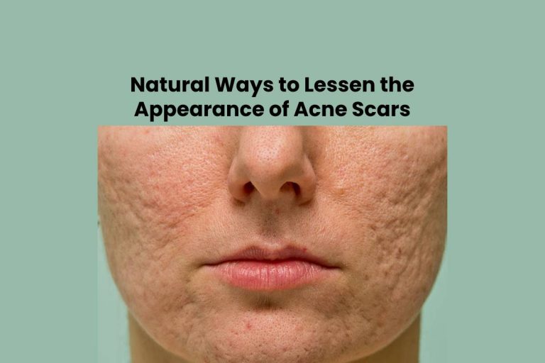 Natural Ways to Lessen the Appearance of Acne Scars